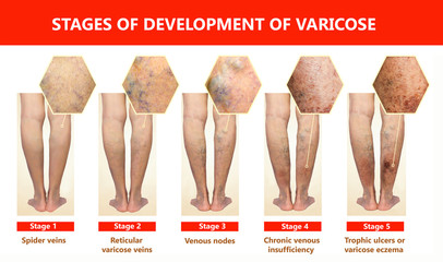 Varicose veins on a female senior leg