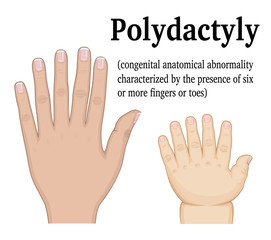 Illustration of Polydactyly