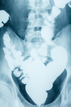 X-ray image plain abdomen , colon