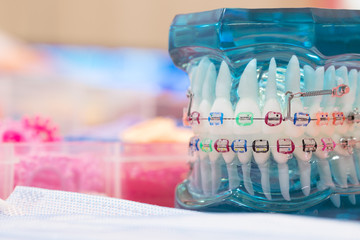 orthodontic model and dentist tool - demonstration teeth model of varities of orthodontic bracket or brace