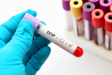 Naklejka premium Blood sample positive with DCIP test, hemoglobin E thalassemia diagnosis 