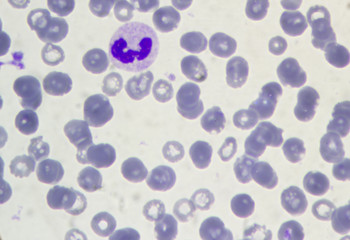 .Blood under a microscope. Lymphocyte