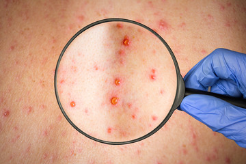 epidemic Rubella viral infection concept. skin bubble rash