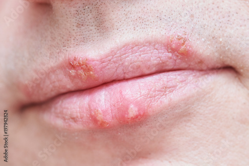 Herpes Simplex Virus Infection On Male Face Lips Stockfotos Und