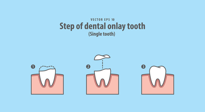 Step of dental onlay tooth (Single tooth) illustration vector on blue background. Dental concept.