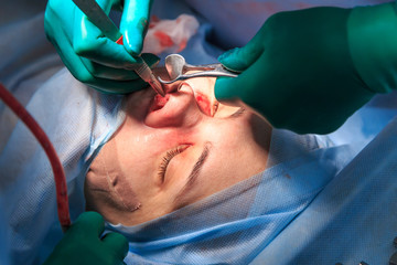 Plastic surgery of the nose in operating room, rhinoplasty