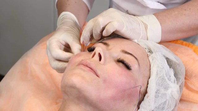Healtcare clinic. Young female client gets thread face lifting procedure. Beautician in gloves making face anti-aging to a female face