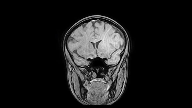 Computed medical tomography MRI upscaled scan of healthy young female head. Front view. Optically retimed for smooth motion. Original black-and-white on black background.