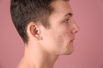 Fototapeta premium Young man with acne problem on color background