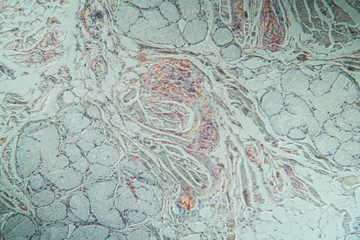 krankes Gewebe unter dem Mikroskop 200x