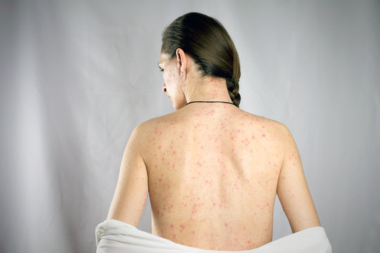 chickenpox viral infection concept. girls back skin rashes