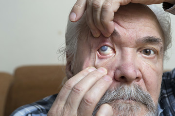 Eye disease in an old man