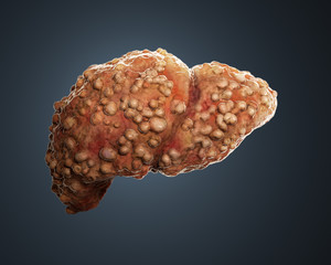 3d rendered cirrotic liver.