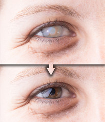 Eye with cataract and corneal opacity before and after surgery