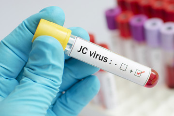 Blood sample positive with JC virus 
