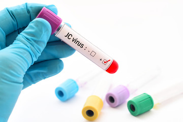 Obraz premium Blood sample positive with JC virus 