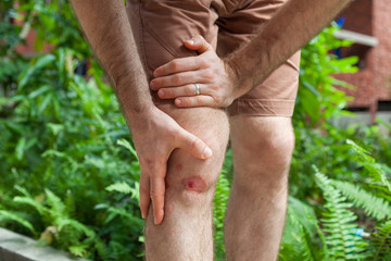 Close up on an bleeding scraped human knee after run accident. Wound from exhaust motorcycle.