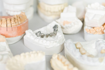 Metal prosthesis on plaster cast of human teeth