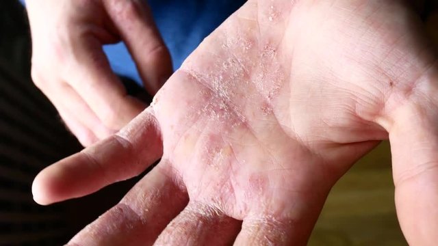 The man scratches his hands. Very itchy fingers, psoriasis.