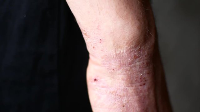 The man scratches his hands. Very itchy fingers, psoriasis.
