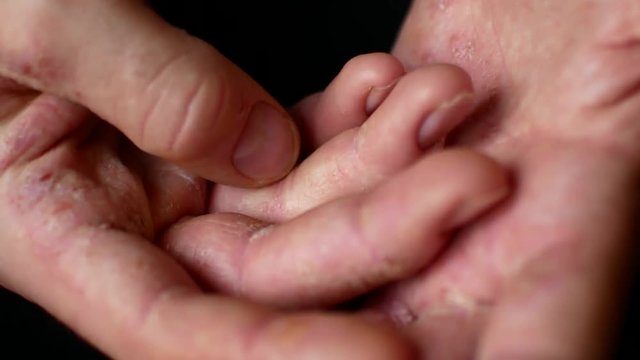 Sick men's hands ask for charity. Hands of a man with psoriasis.