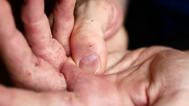 Sick men's hands ask for charity. Hands of a man with psoriasis.