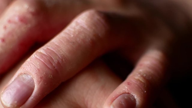 The man scratches his hands. Very itchy fingers, psoriasis.