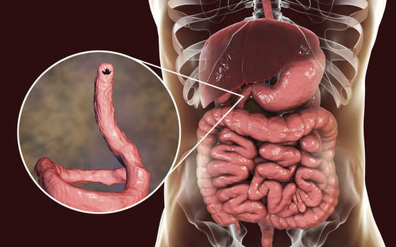 Parasitic hookworm Ancylosoma duodenale in human duodenum