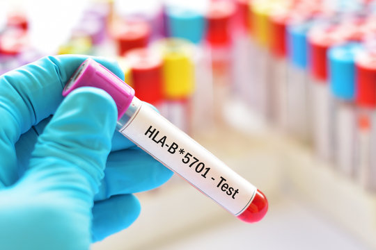 Blood sample for HLA-B*5701 test, diagnosis for hypersensitivity to antiretroviral (ARV) drug abacavir