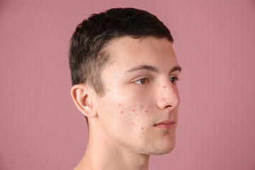 Naklejka premium Young man with acne problem on color background
