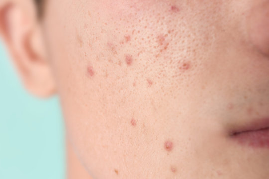 Young man with acne problem, closeup