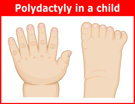 Illustration Of Polydactyly In A Child