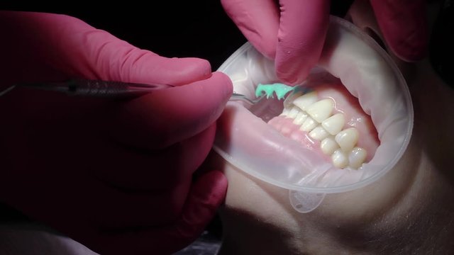 Dentist removing liquid cofferdam in dental clinic
