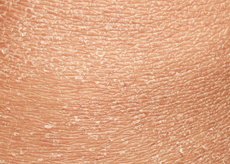  texture of the epidermis of human skin with flakes and cracked particles closeup - obrazy, fototapety, plakaty
