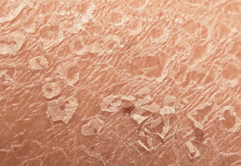  texture of the unhealthy human skin epidermis with flaky and cracked particles close up