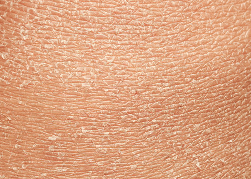  Texture Of The Epidermis Of Human Skin With Flakes And Cracked Particles Closeup