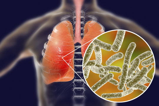 Legionella pneumophila bacteria in human lungs, 3D illustration, the causative agent of Legionnaire's disease
