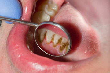 Close-up of macro dental calculus and dental plaque. Oral hygiene in dentistry