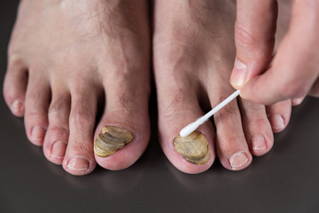 nail fungus care or nail fungus treatment.   © Fertas