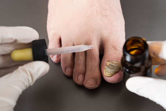 nail fungus care or nail fungus treatment.  