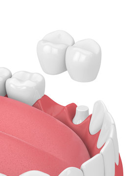 3d render of jaw with dental cantilever bridge
