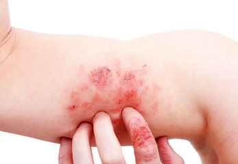 Atopic dermatitis (AD), also known as atopic eczema, is a type of inflammation of the skin...