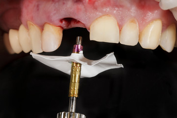 installation of dental abutment in the upper jaw, for a ceramic tooth © Dental Pro Content