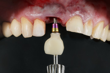 installation of a ceramic tooth in the upper jaw during operation