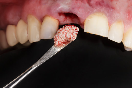 dental procedure, addition of artificial bone, for dental implantation