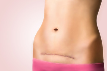 beautiful female belly with a scar after cesarean section