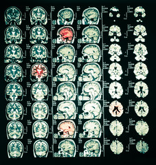 mri scan or magnetic resonance image of head and brain scan.