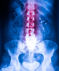 Xray of stomah and pelvis section