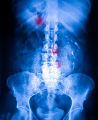 Xray of stomah and pelvis section