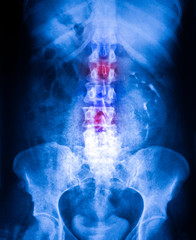 Xray of stomah and pelvis section